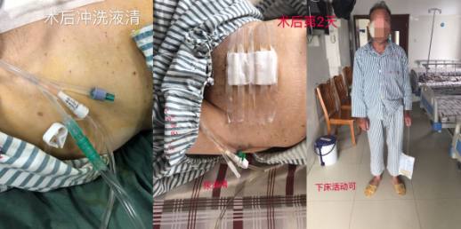 我院順利地為高齡前列腺增生加巨大膀胱結(jié)石患者 解決多年疾病困擾
